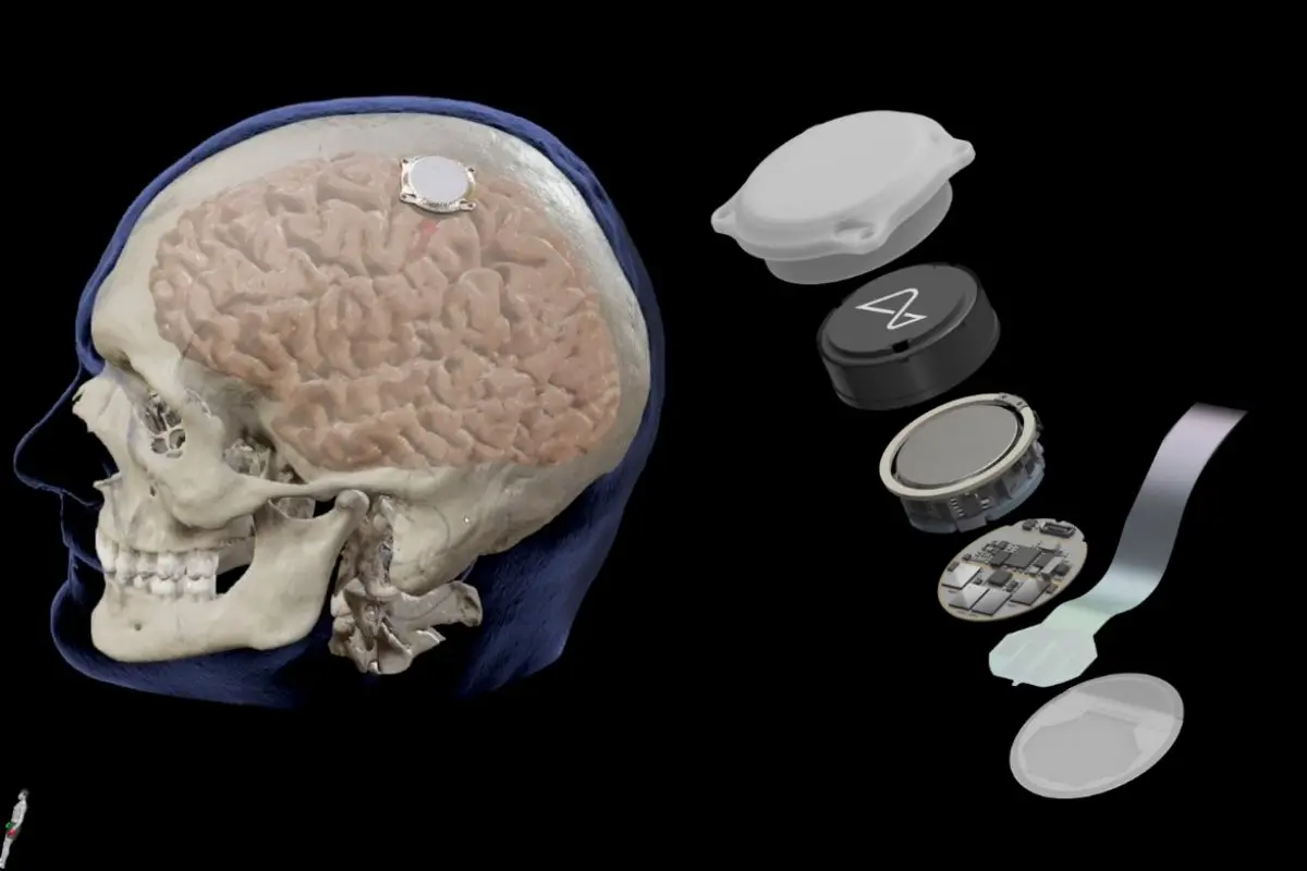 El primer implante de Neuralink se desprendió parcialmente del cerebro del paciente